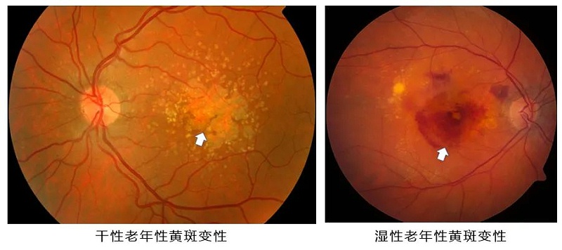 水蛭素、黃斑變性