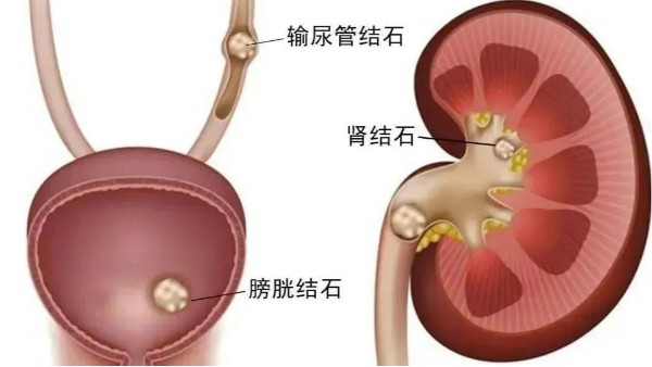 重用、活用水蛭治療尿路結(jié)石，療效較好