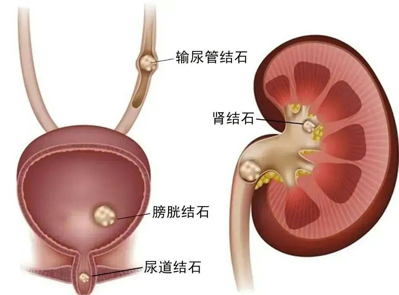 水蛭素、尿路結(jié)石、腎功能