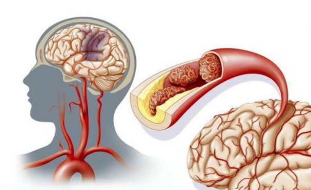 水蛭素、急性腦梗死、中風