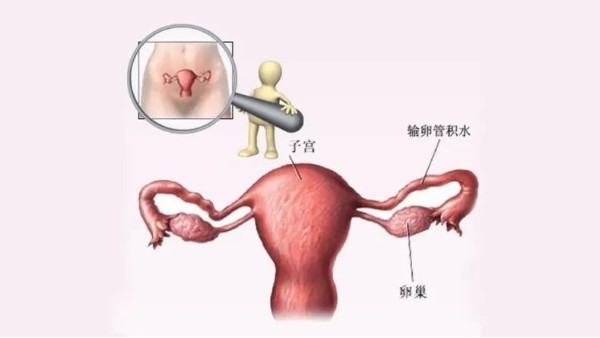 水蛭有利水道、破積聚之功，可用于治療輸卵管積水