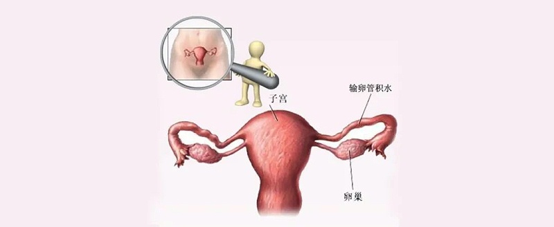 水蛭素、輸卵管積水、不孕不育