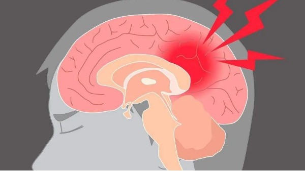 水蛭治療缺血性腦血管病療效肯定、安全簡便，已被各家公認