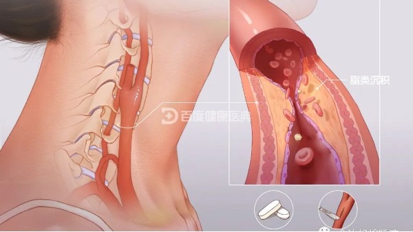 真實(shí)案例 | 從有到無，一個月多雙頸動脈斑塊“消失術(shù)”