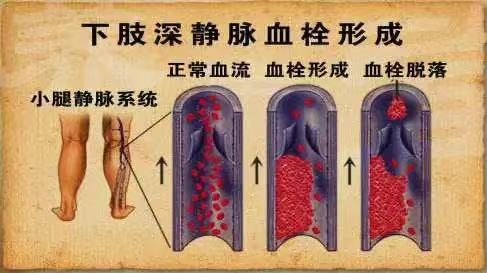 水蛭素、水蛭素膠囊、壯醫(yī)水蛭療法