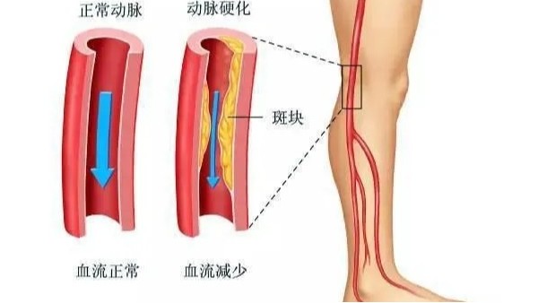 水蛭在改善下肢動(dòng)脈硬化性閉塞癥中發(fā)揮重要療效，安全性及可行性較高