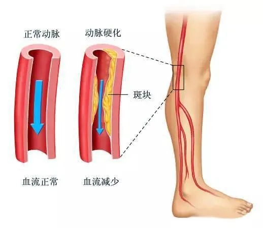 水蛭素、下肢動脈硬化、下肢閉塞