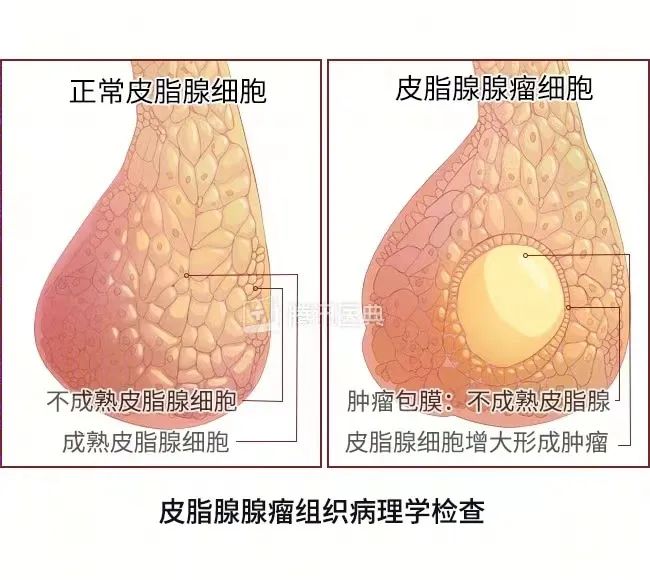 壯醫(yī)水蛭療法，天然水蛭素膠囊