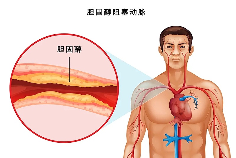 水蛭素、脖子粗、血管硬化