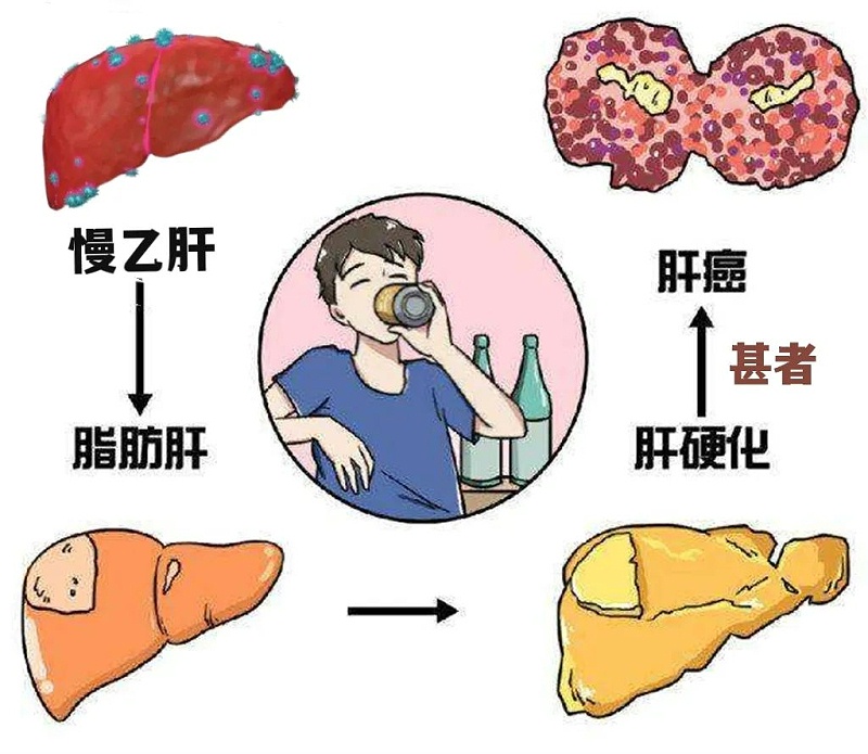 水蛭素、肝硬化、脂肪肝