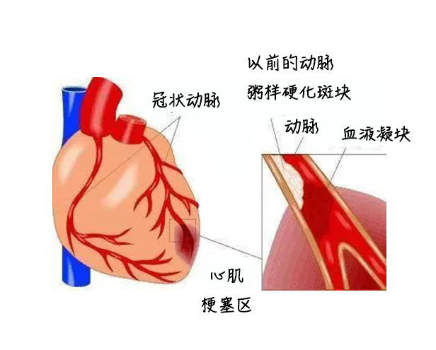 中醫(yī)藥健康旅游、心梗、面癱