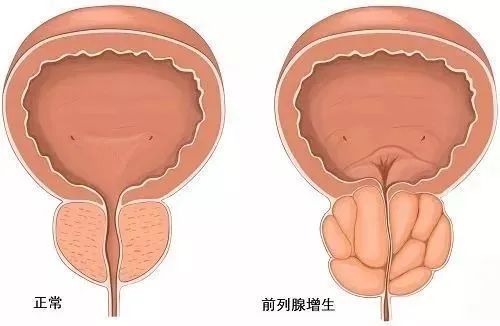 水蛭素、前列腺增生、前列腺肥大