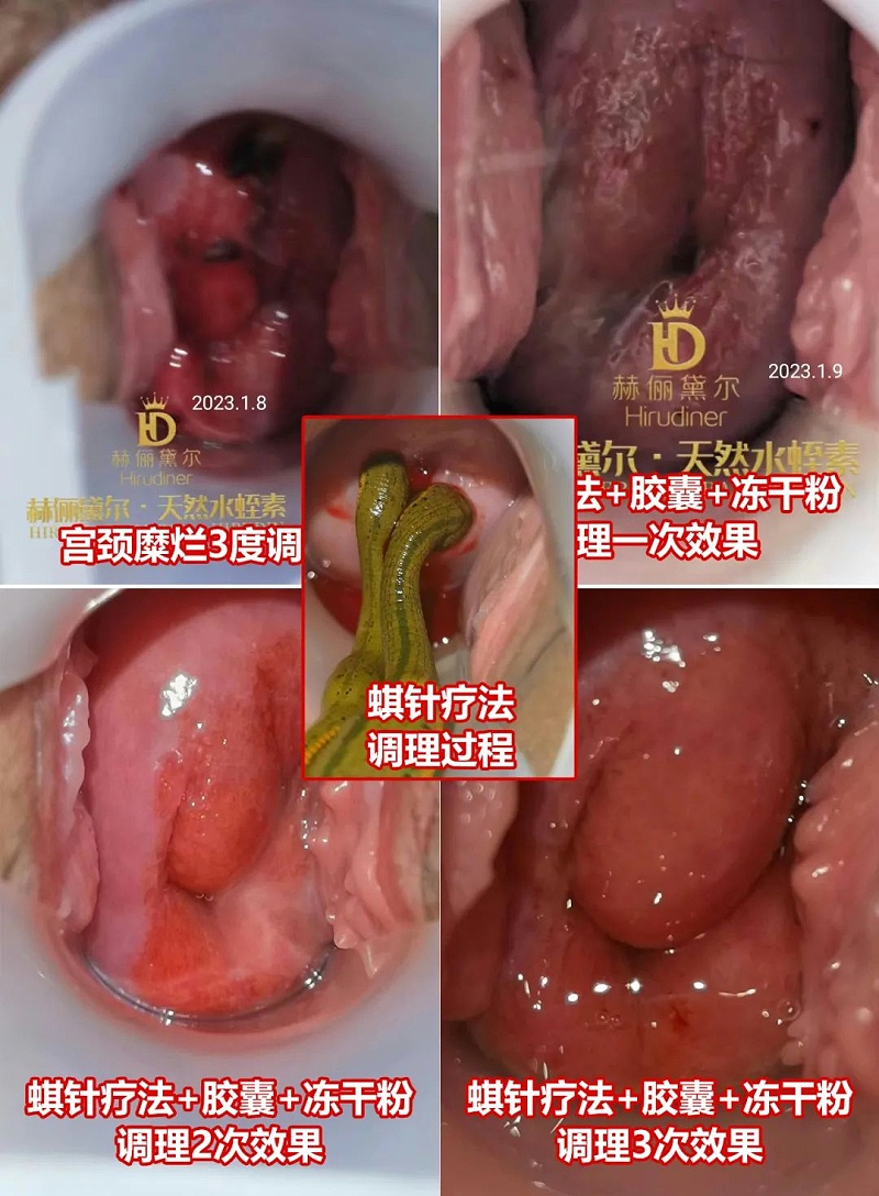 水蛭素、水蛭素膠囊、生殖婦科