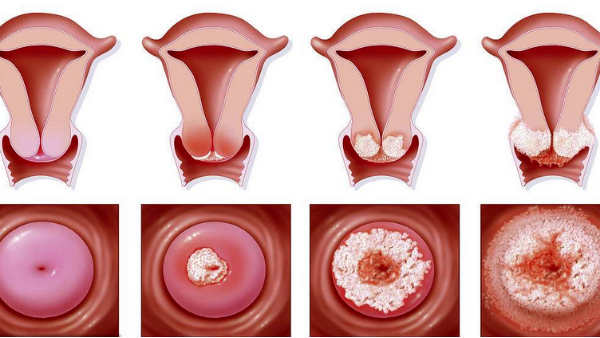 得了「宮頸糜爛」，怎么辦？