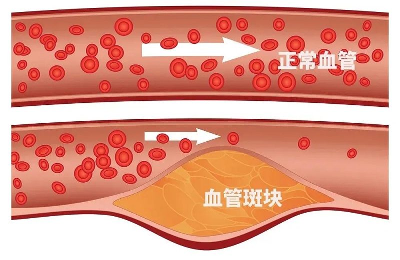 水蛭素、通血管、血管堵塞