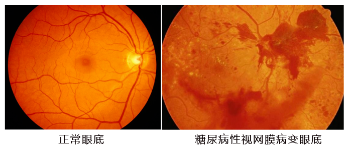 水蛭素、糖尿病、視網膜病變