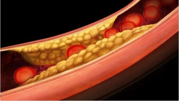 三高如何引起動脈粥樣硬化斑塊？——高血壓篇