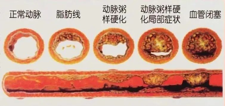 水蛭素、動(dòng)脈粥樣硬化、高血壓