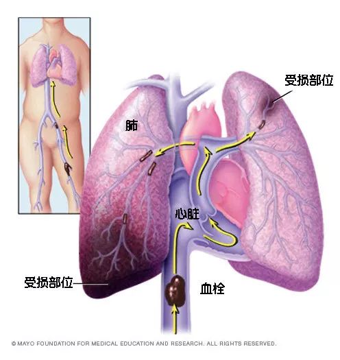 水蛭素、猝死、心梗